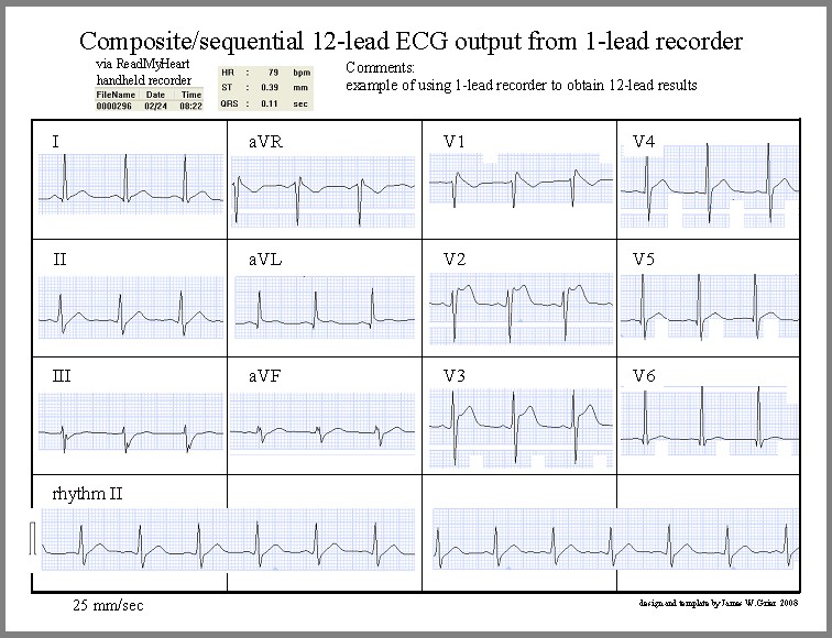 Electrocardiography The Monitoring Lead