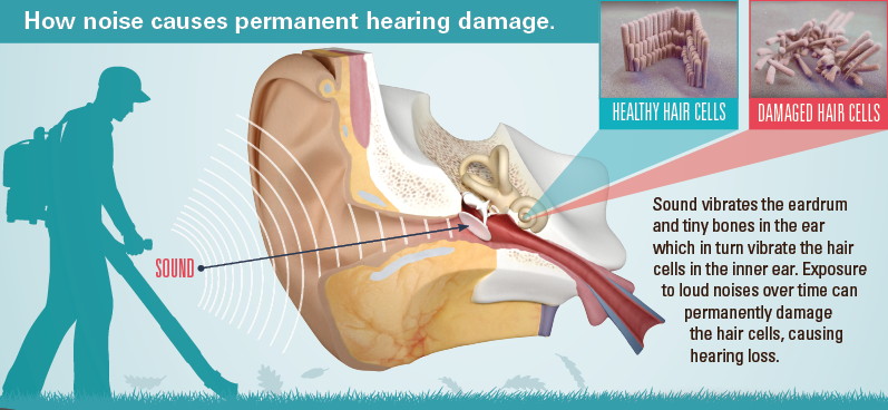 How noise causes permanent hearing damage