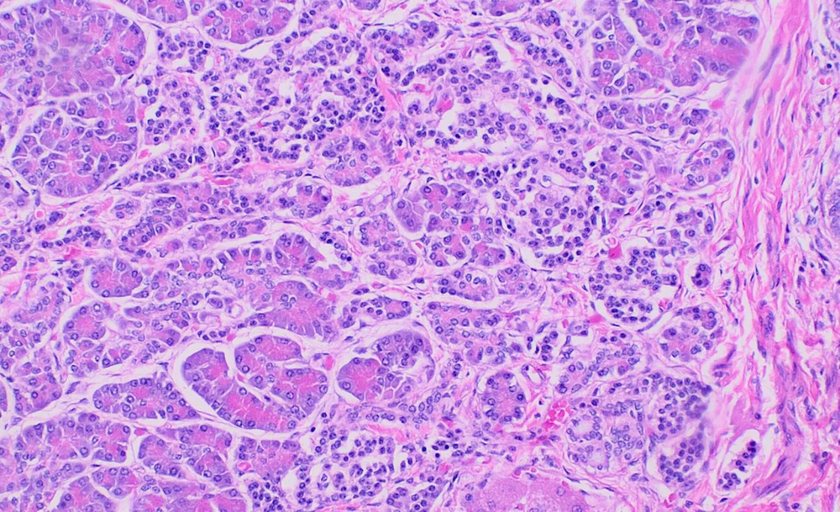 Histopathology of pancreatic tissue in a mature cystic teratoma